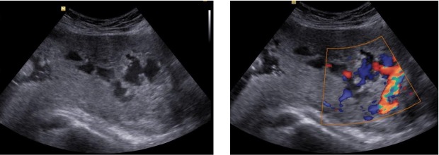 Evaluation of the Relationship Between Quantitative Ultrasound Findings and Morbidly Adherent Placenta.