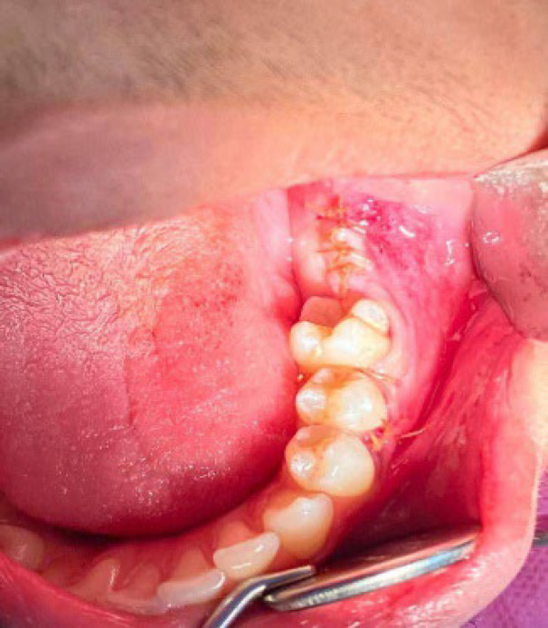 A Rare Case of Orthokeratinized Odontogenic Cyst (OOC) in the Posterior Mandible of a Young Adult 18-Year-Old Boy.