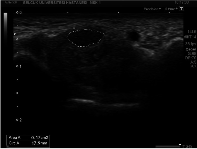 Carpal Tunnel Syndrome in Patients with Psoriatic Arthritis: Ultrasonography and Magnetic Resonance Imaging Findings.