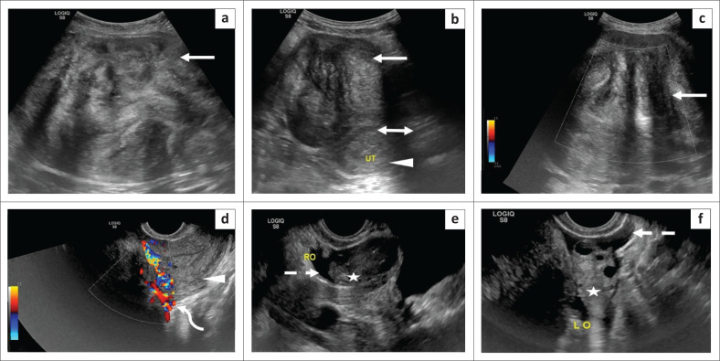 Torsion of a huge subserosal uterine leiomyoma: A challenging case of acute abdomen.