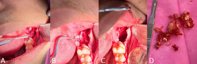 A Rare Case of Orthokeratinized Odontogenic Cyst (OOC) in the Posterior Mandible of a Young Adult 18-Year-Old Boy.