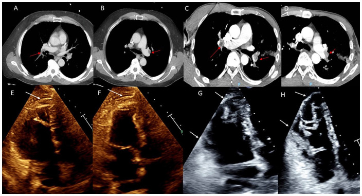 Reverse McConnell's: A Sign of Acute Pulmonary Embolism.