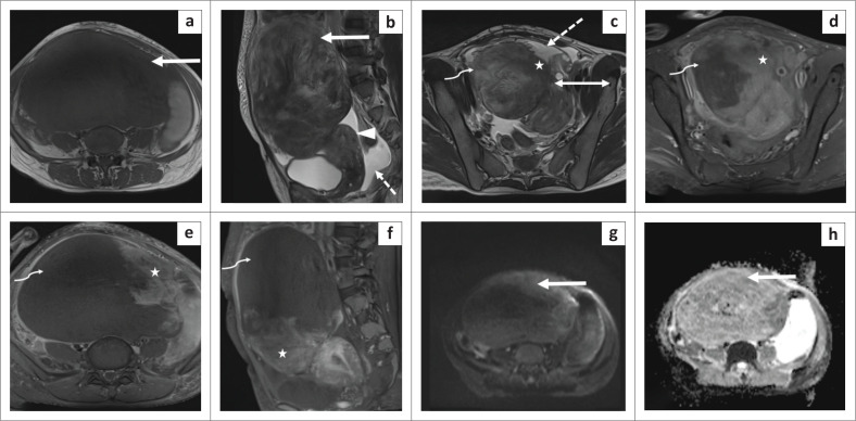 Torsion of a huge subserosal uterine leiomyoma: A challenging case of acute abdomen.