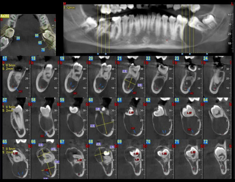 A Rare Case of Orthokeratinized Odontogenic Cyst (OOC) in the Posterior Mandible of a Young Adult 18-Year-Old Boy.