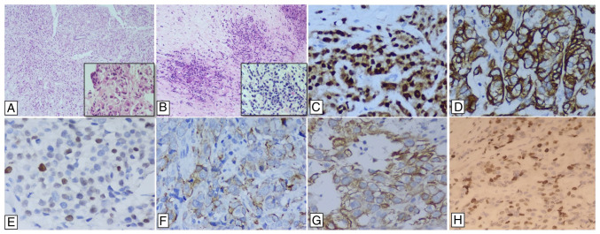 Characterization of triple negative breast cancer gene expression profiles in Mexican patients.