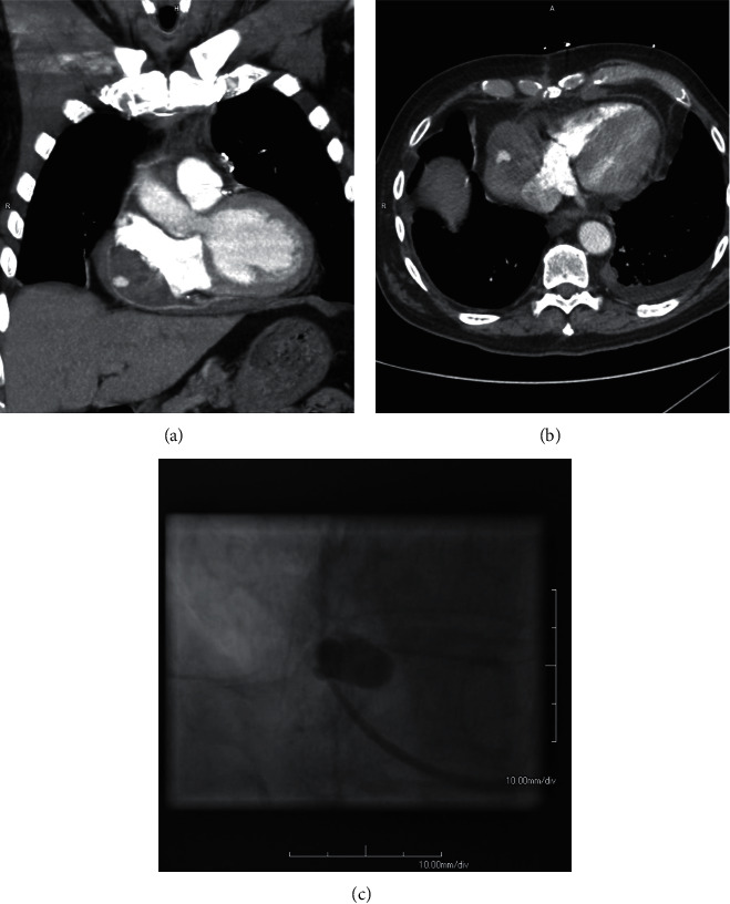 Spontaneous Closure of a Coronary Artery Bypass Graft Pseudoaneurysm Embedded in a Mediastinal Hematoma.