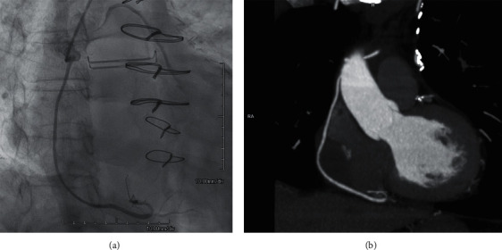 Spontaneous Closure of a Coronary Artery Bypass Graft Pseudoaneurysm Embedded in a Mediastinal Hematoma.