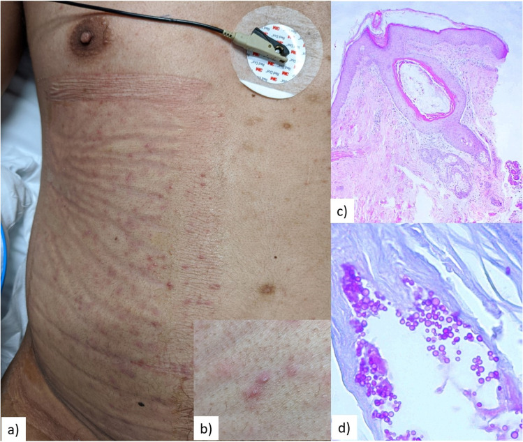 <i>Malassezia</i> Folliculitis in the Setting of COVID-19.