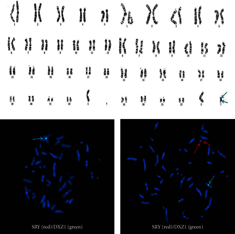 45, X/ 46, X, psu idic (Y) (q11.2) Mosaicism in a Primary Amenorrhea Girl with Swyer Syndrome.