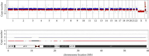 45, X/ 46, X, psu idic (Y) (q11.2) Mosaicism in a Primary Amenorrhea Girl with Swyer Syndrome.