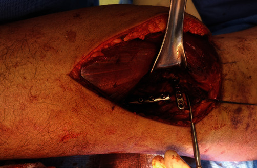 Posteromedial Submeniscal Arthrotomy and Fixation with a Posteromedial Rim Plate in a Comminuted Medial Tibial Plateau Fracture.