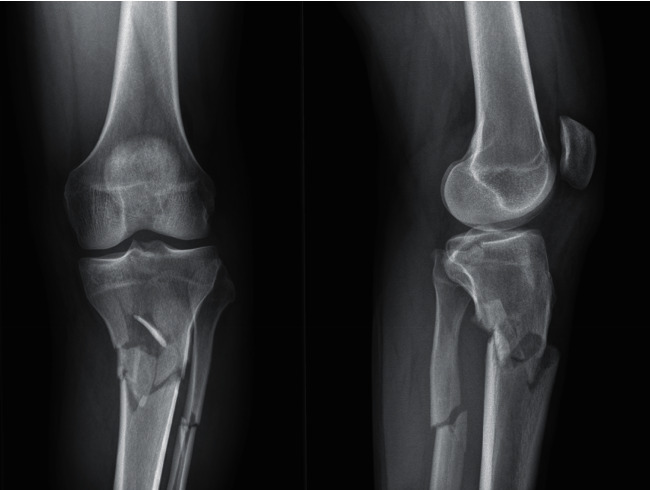 Posteromedial Submeniscal Arthrotomy and Fixation with a Posteromedial Rim Plate in a Comminuted Medial Tibial Plateau Fracture.