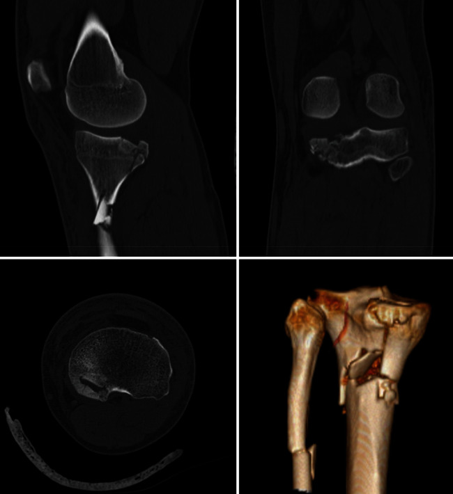 Posteromedial Submeniscal Arthrotomy and Fixation with a Posteromedial Rim Plate in a Comminuted Medial Tibial Plateau Fracture.