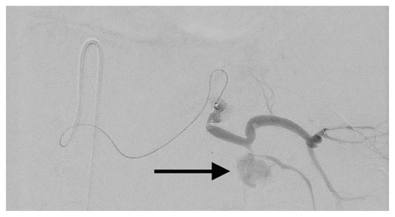 Splenic Artery Pseudoaneurysm in a Septic Patient with Acute Pancreatitis.