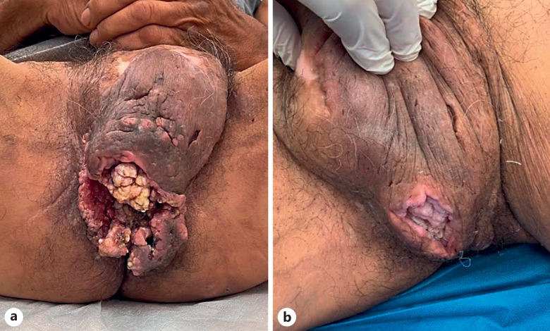 Advanced Squamous Cell Carcinoma Developed on Chronic Hidradenitis Suppurativa, Successfully Treated with Cemiplimab: A Case Report.