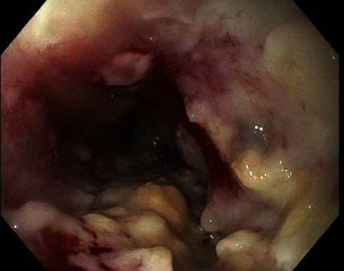 Acquiring the Diagnosis of an Acquired Tracheoesophageal Fistula with EtCO<sub>2</sub>: A Case Discussion with Review of the Literature.