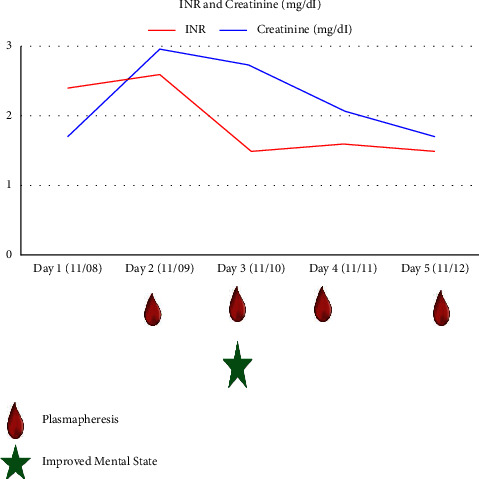 Plasmapheresis for Fulminant Wilson's Disease Improves Mental Status and Coagulopathy.