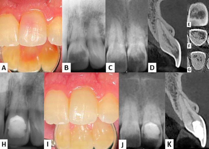 Management of Pink Spot due to Class IV Invasive Cervical Root Resorption using Vital Pulp Therapy: A Case Report.