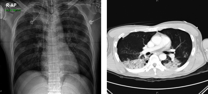 Association of Chest Anteroposterior Radiography with Computed Tomography in Patients with Blunt Chest Trauma.