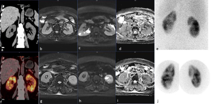 Localization of Pyelonephritis by <sup>68</sup>Ga-FAPI PET CT.