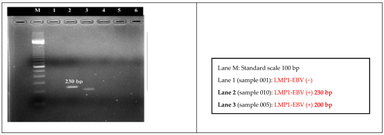 LMP1-EBV Gene Deletion Mutations and HLA Genotypes of Nasopharyngeal Cancer Patients in Vietnam.