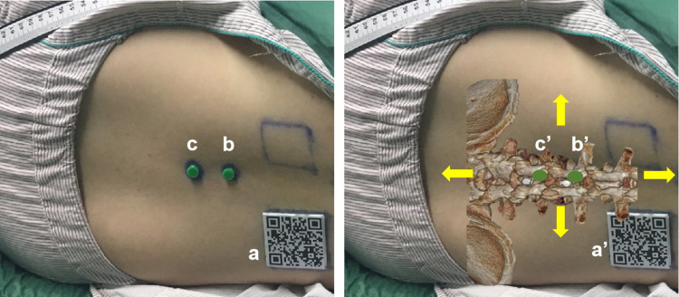 Accuracy Evaluation Trial of Mixed Reality-Guided Spinal Puncture Technology.