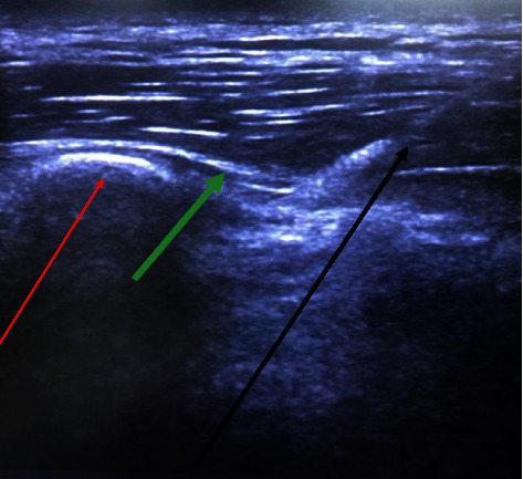 Erector Spinae Plane (ESP) Block for Postoperative Pain Management after Open Oncologic Abdominal Surgery.