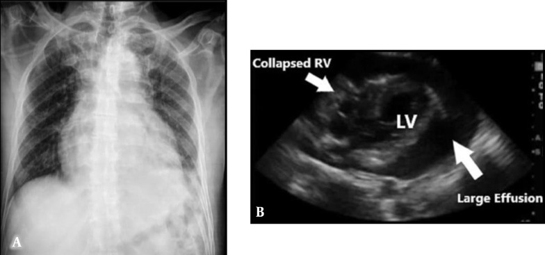 Recurrent Pericardial Effusion Due to Panhypopituitarism: A Rare Case Report.