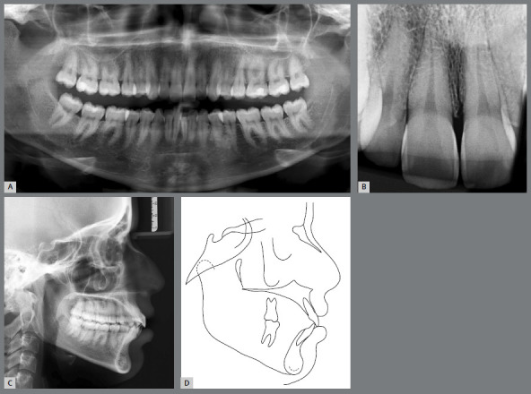 MARPE as an adjunct to orthodontic treatment.