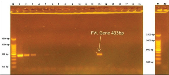 Prevalence of Panton-Valentine leukocidin and toxic shock syndrome toxin-1 genes in methicillin-resistant <i>Staphylococcus aureus</i> isolated from nose of restaurant workers in Kirkuk city.