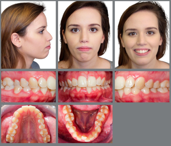 MARPE as an adjunct to orthodontic treatment.
