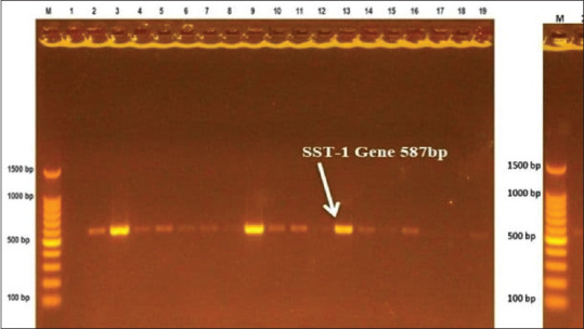 Prevalence of Panton-Valentine leukocidin and toxic shock syndrome toxin-1 genes in methicillin-resistant <i>Staphylococcus aureus</i> isolated from nose of restaurant workers in Kirkuk city.