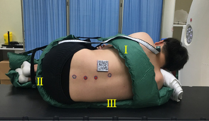 Accuracy Evaluation Trial of Mixed Reality-Guided Spinal Puncture Technology.