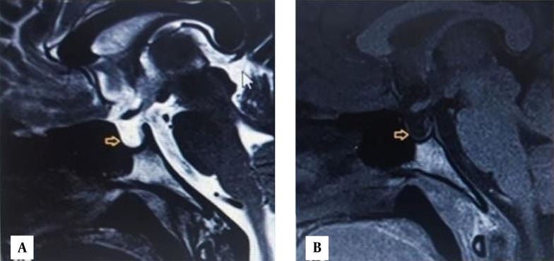 Recurrent Pericardial Effusion Due to Panhypopituitarism: A Rare Case Report.