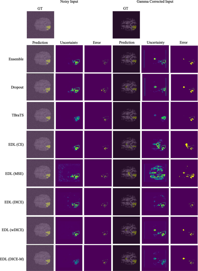 Region-based evidential deep learning to quantify uncertainty and improve robustness of brain tumor segmentation.