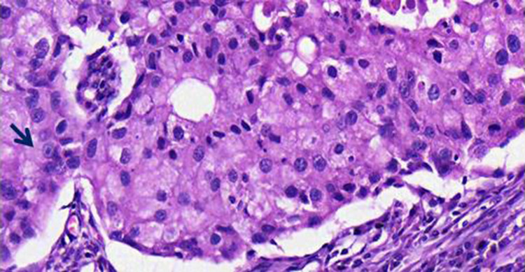 Pregnancy Associated Invasive Apocrine Carcinoma of the Breast: Case Report from Ethiopia.