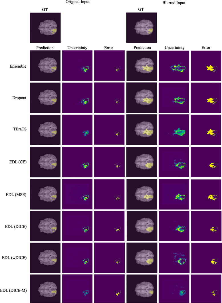 Region-based evidential deep learning to quantify uncertainty and improve robustness of brain tumor segmentation.