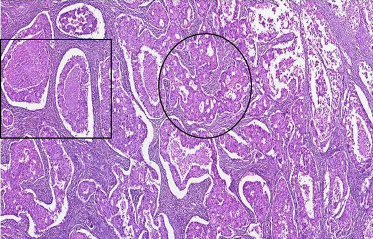 Pregnancy Associated Invasive Apocrine Carcinoma of the Breast: Case Report from Ethiopia.