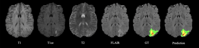 Region-based evidential deep learning to quantify uncertainty and improve robustness of brain tumor segmentation.