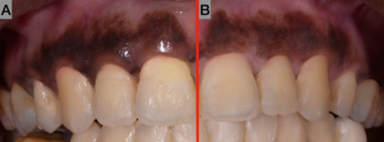 Validity and Reliability of Polarized vs Non-Polarized Digital Images for Measuring Gingival Melanin Pigmentation.