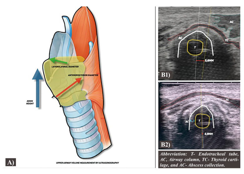 Ultrasound protocol in odontogenic infections: a new proposal.