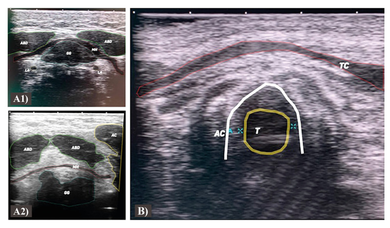 Ultrasound protocol in odontogenic infections: a new proposal.