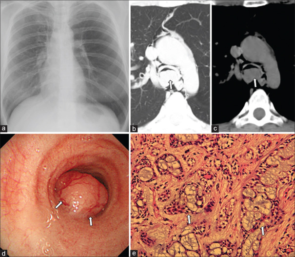 Tracheobronchial adenoid cystic carcinoma mimicking bronchial asthma.