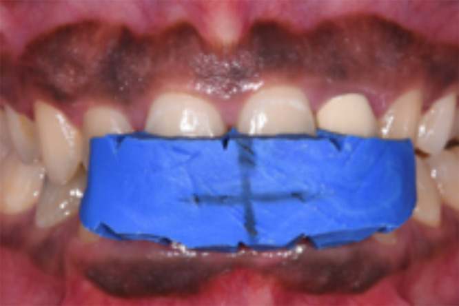 Validity and Reliability of Polarized vs Non-Polarized Digital Images for Measuring Gingival Melanin Pigmentation.