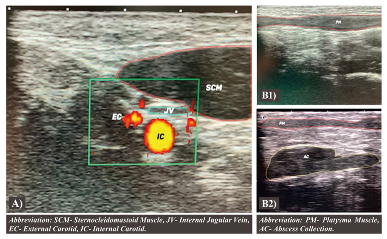 Ultrasound protocol in odontogenic infections: a new proposal.