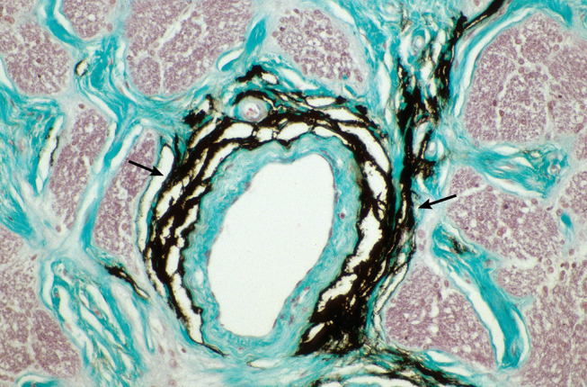 Normal-Tension Glaucoma: A Glymphopathy?