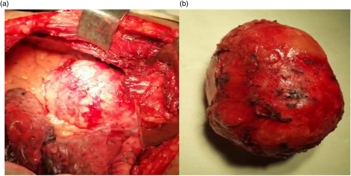 Unusual cause of mediastinal tumor: A case of calcified pericardial cyst.