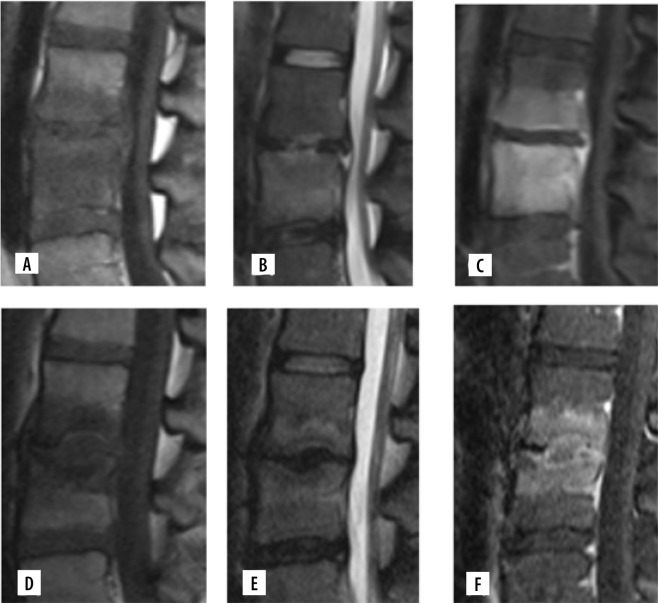 Finding MRI features to obviate the need of repeat spinal biopsies in clinically suspected persistent or recurrent spinal osteomyelitis.