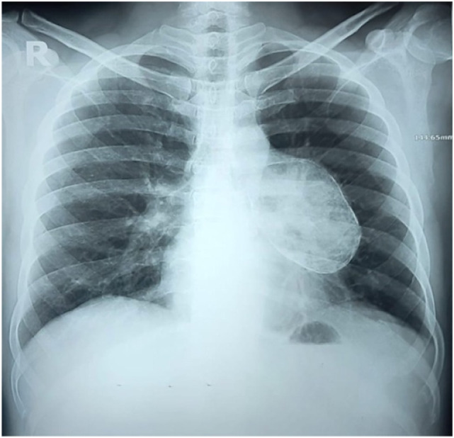 Unusual cause of mediastinal tumor: A case of calcified pericardial cyst.