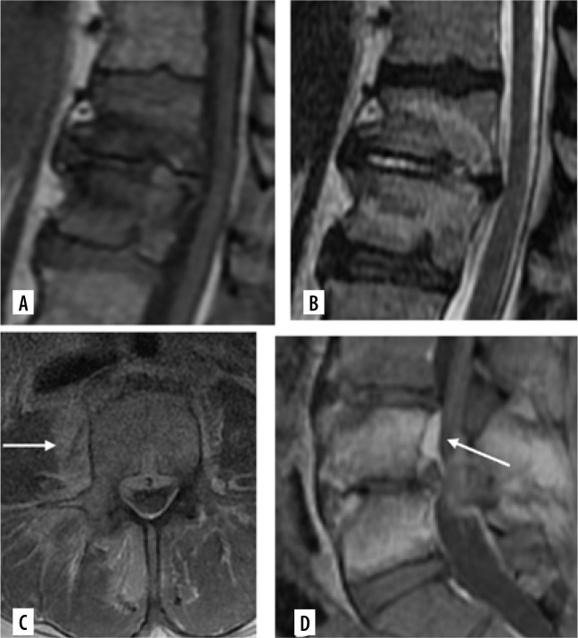 Finding MRI features to obviate the need of repeat spinal biopsies in clinically suspected persistent or recurrent spinal osteomyelitis.